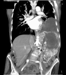 Renal Cell Carcinoma With Spread Through Diaphragm - CTisus CT Scan