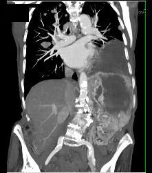 Renal Cell Carcinoma With Spread Through Diaphragm - CTisus CT Scan