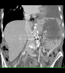 Renal Cell Carcinoma With Spread Through Diaphragm - CTisus CT Scan