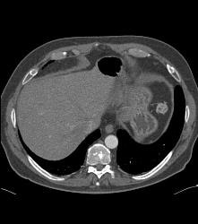 Post Left Nephrectomy Bed - CTisus CT Scan