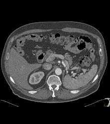 Post Left Nephrectomy Bed - CTisus CT Scan