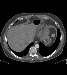 Post Left Nephrectomy Bed - CTisus CT Scan