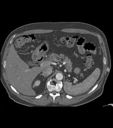 Post Left Nephrectomy Bed - CTisus CT Scan