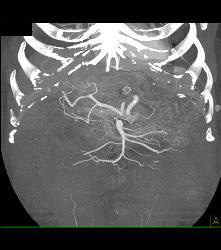 Post Left Nephrectomy Bed - CTisus CT Scan