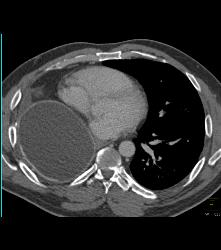 Post Left Nephrectomy Bed - CTisus CT Scan