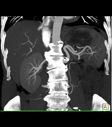 Post Left Nephrectomy Bed - CTisus CT Scan