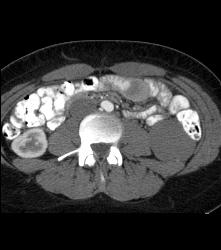 Cystic Left Renal Cell Carcinoma - CTisus CT Scan