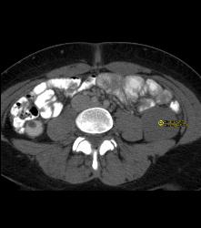 Cystic Left Renal Cell Carcinoma - CTisus CT Scan