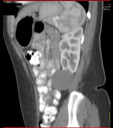 Cystic Left Renal Cell Carcinoma - CTisus CT Scan