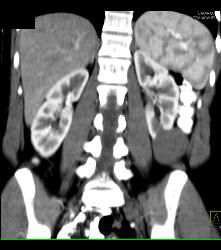 Cystic Left Renal Cell Carcinoma - CTisus CT Scan