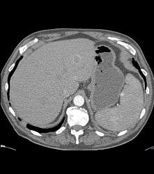 Recurrent Renal Cell Carcinoma Near Splenic Bed - CTisus CT Scan