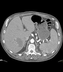 Recurrent Renal Cell Carcinoma Near Splenic Bed - CTisus CT Scan