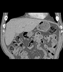 Recurrent Renal Cell Carcinoma Near Splenic Bed - CTisus CT Scan