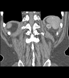 Recurrent Renal Cell Carcinoma Near Splenic Bed - CTisus CT Scan