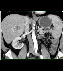 Recurrent Renal Cell Carcinoma Near Splenic Bed - CTisus CT Scan