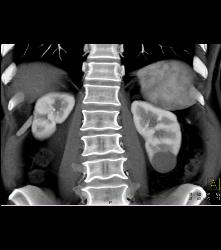 Cystic Left Renal Mass - CTisus CT Scan