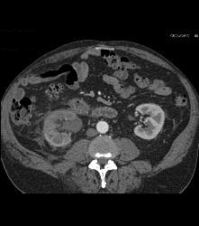 Distal Right Ureteral Tumor - CTisus CT Scan