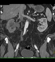 Distal Right Ureteral Tumor - CTisus CT Scan