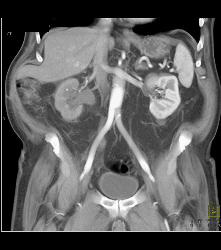 Distal Right Ureteral Tumor - CTisus CT Scan