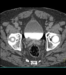 Distal Right Ureteral Tumor - CTisus CT Scan