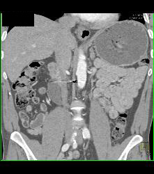 Distal Right Ureteral Tumor - CTisus CT Scan