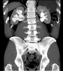 Distal Right Ureteral Tumor - CTisus CT Scan