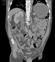 Distal Right Ureteral Tumor - CTisus CT Scan