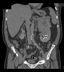 Distal Right Ureteral Tumor - CTisus CT Scan