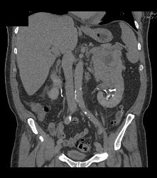 Distal Right Ureteral Tumor - CTisus CT Scan