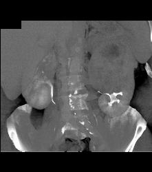 Left Renal Cell Carcinoma - CTisus CT Scan