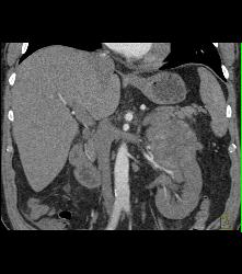 Left Renal Cell Carcinoma - CTisus CT Scan