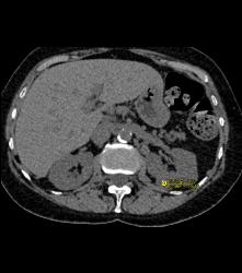 Complex Left Renal Cyst - CTisus CT Scan