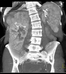 Large Right Renal Angiomyolipoma (AML) With Arteriovenous (AV) Shunting - CTisus CT Scan