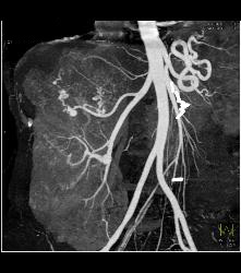 Large Right Renal Angiomyolipoma (AML) With Arteriovenous (AV) Shunting - CTisus CT Scan