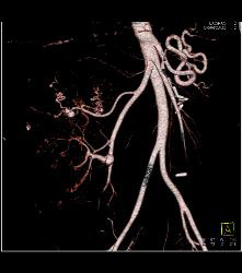 Large Right Renal Angiomyolipoma (AML) With Arteriovenous (AV) Shunting - CTisus CT Scan