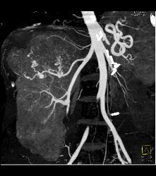 Large Right Renal Angiomyolipoma (AML) With Arteriovenous (AV) Shunting - CTisus CT Scan