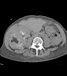 Large Right Renal Angiomyolipoma (AML) With Arteriovenous (AV) Shunting - CTisus CT Scan