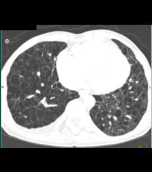 Angiomyolipoma (AML) and Lymphangiomyomatosis - CTisus CT Scan