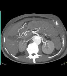 Reimplanted Renal Artery - CTisus CT Scan