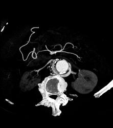 Reimplanted Renal Artery - CTisus CT Scan