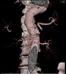 Reimplanted Renal Artery - CTisus CT Scan