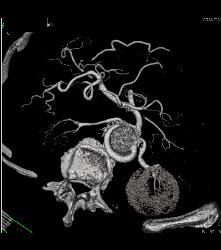 Reimplanted Renal Artery - CTisus CT Scan