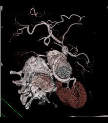 Reimplanted Renal Artery - CTisus CT Scan