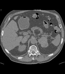 Renal Cell Carcinoma With Bilateral Adrenal Metastases - CTisus CT Scan