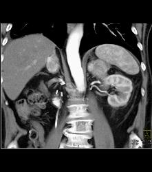 Renal Cell Carcinoma With Bilateral Adrenal Metastases - CTisus CT Scan