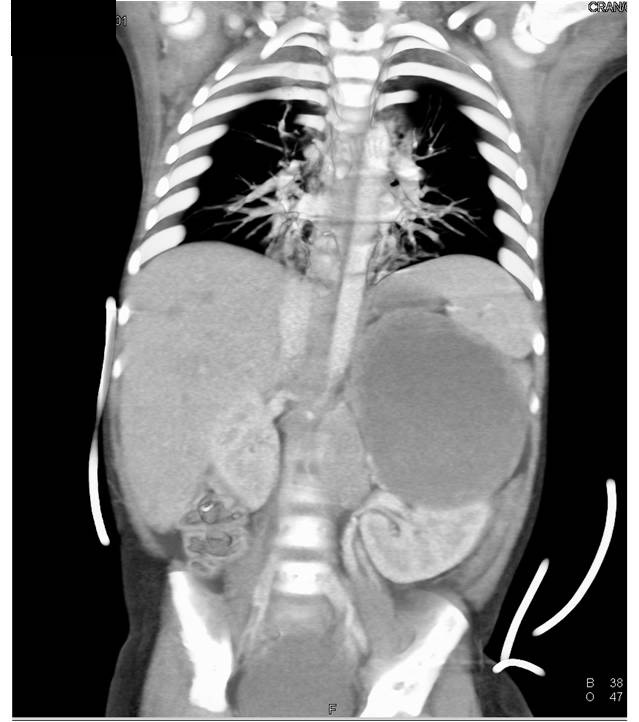 cystic left renal cell carcinoma with adenopathy and liver metastases - CTisus CT Scan