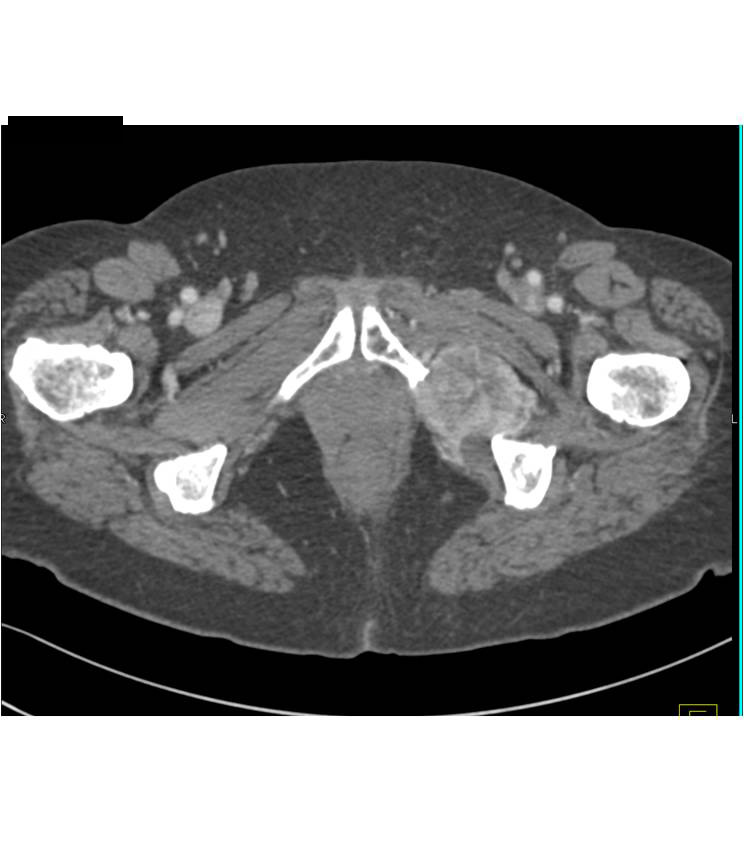 metastatic renal cell carcinoma to bone with vascular metastases - CTisus CT Scan