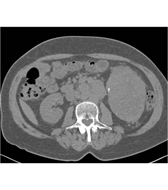 Clear Cell Renal Cell Carcinoma with Bulky Adenopathy - CTisus CT Scan