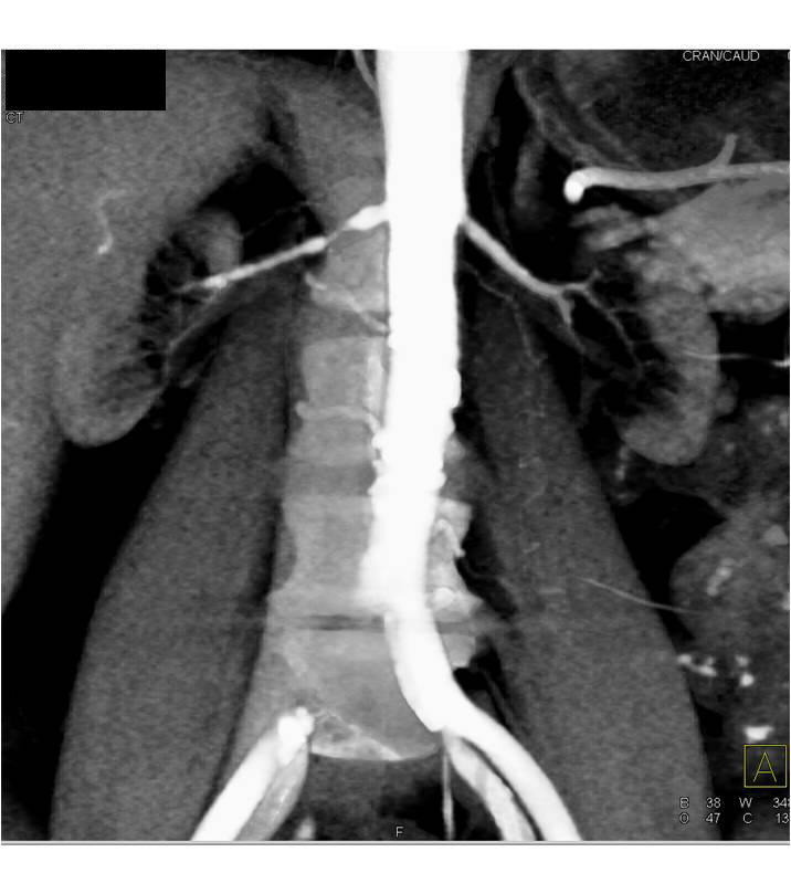 Right Renal Artery Stenosis - CTisus CT Scan