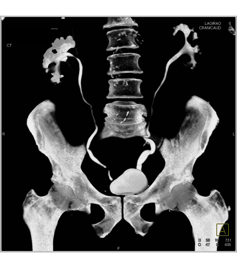 CT Urogram with Dilated Distal Right Ureter - CTisus CT Scan